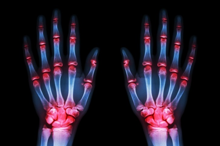 Out of joint: Industry & regulators are highly concerned by latest glucosamine ruling. ©iStock 