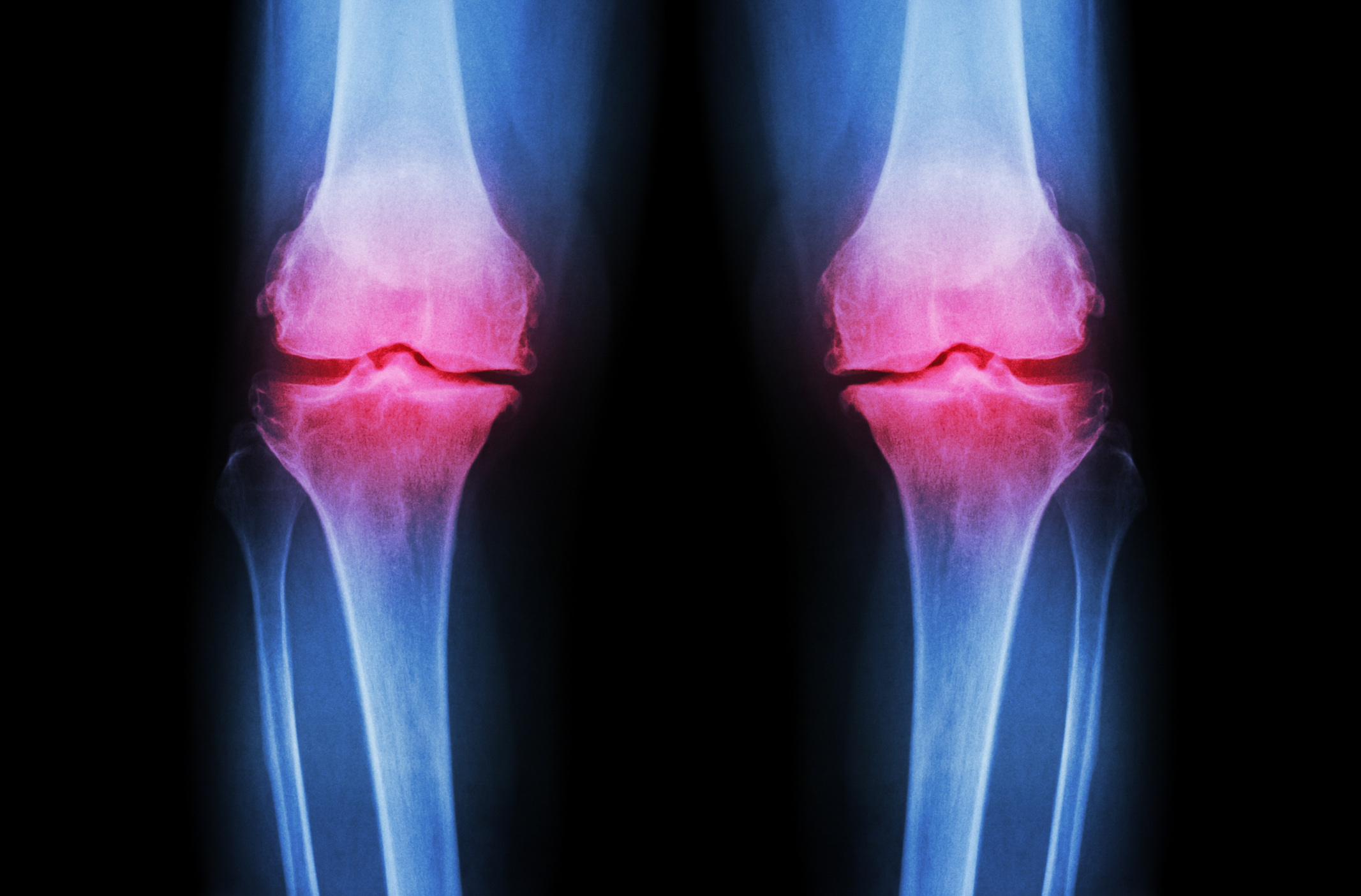 Pycnogenol and joint pain